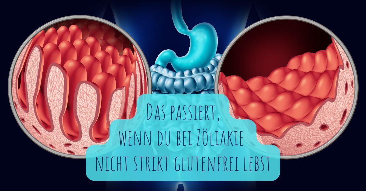 Zöliakie nicht ernst nehmen? Diese Folgen drohen